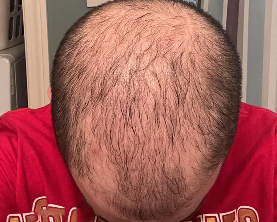 @chrishairjourney hair regrowth journey before photo