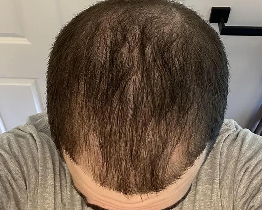 @chrishairjourney hair regrowth journey after photo