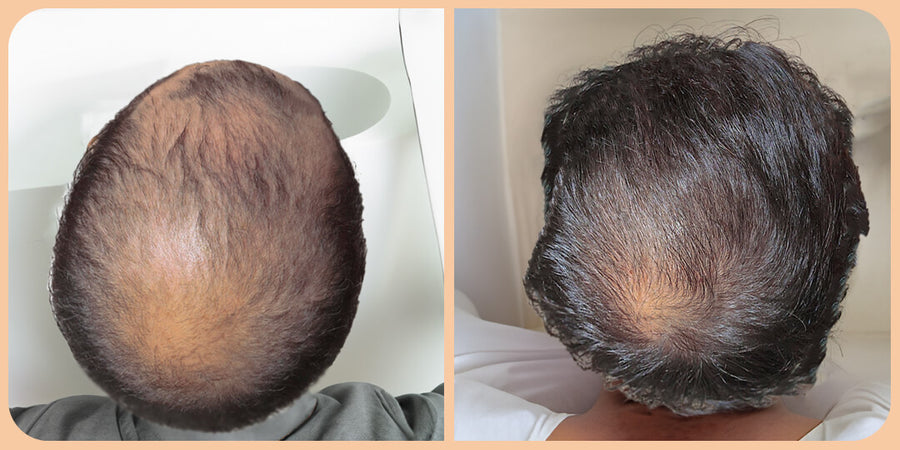 Mane Minoxidil Blend – The Mane Solution
